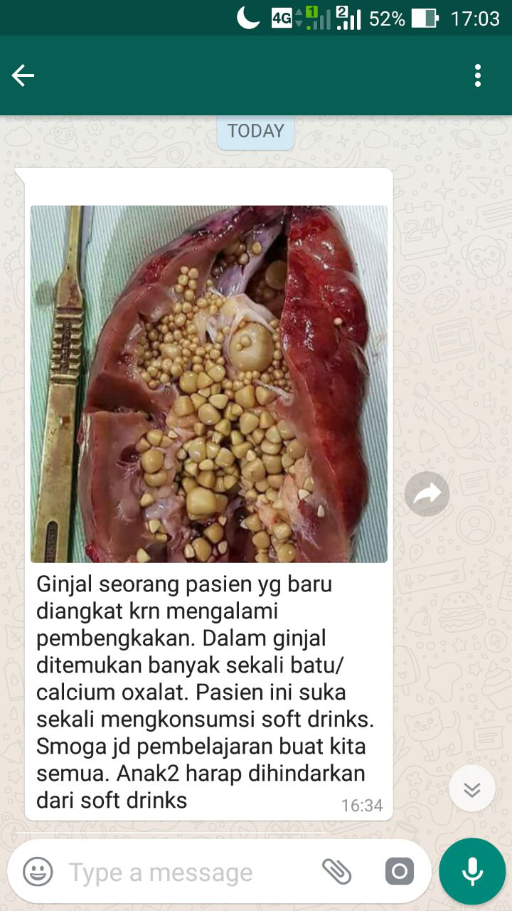 Batu Calcium Oxalate di Ginjal Karena Suka Sekali Konsumsi Soft Drinks